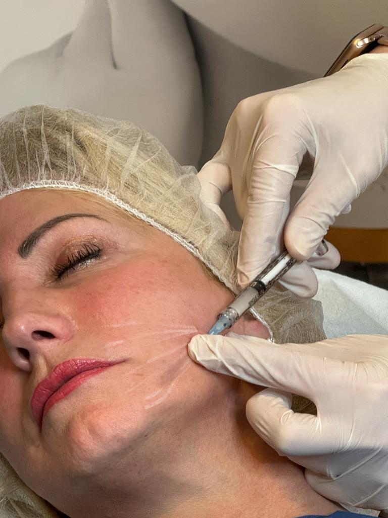 Injektion eines Skin Boosters im Wangenbereich